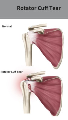 Medical illustration showing a normal rotator cuff and a rotator cuff tear