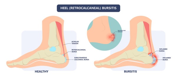 Medical infographic showing a healthy heel and a heel affected by bursitis