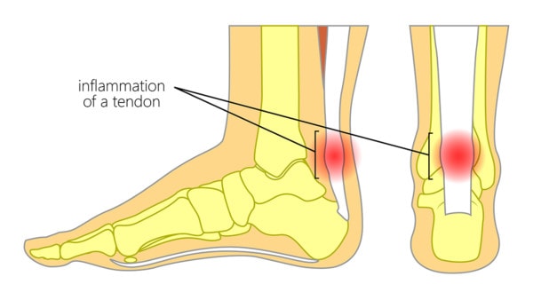 Medical illustration showing two views of inflammation in the Achilles tendon 