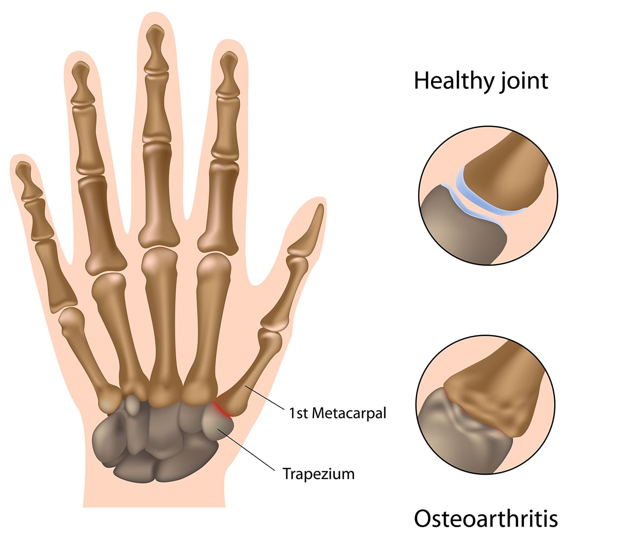 Playing guitar with 2024 thumb arthritis