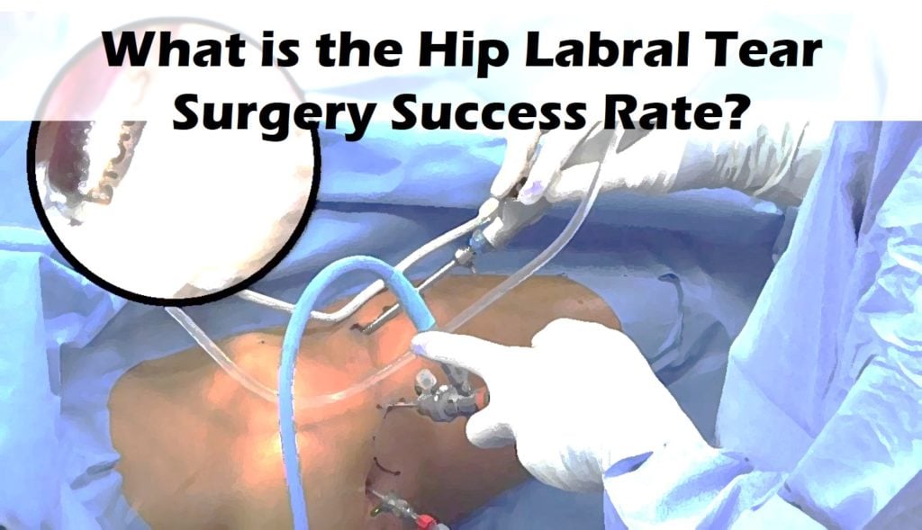 hip-labral-tear-surgery-success-rate