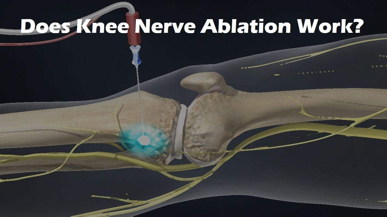 Knee Nerve Block Procedure