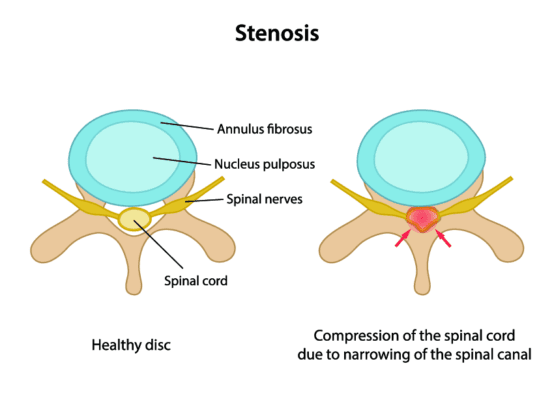 A cross-sectional illustration of a healthy disc (left) versus cervical spinal stenosis (right), which shows compression of the spinal cord due to narrowing of the spinal canal.