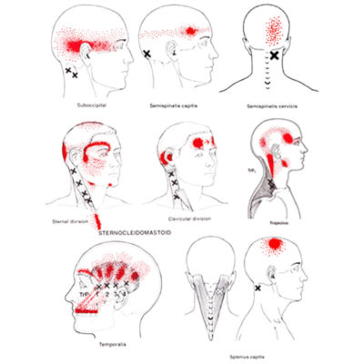 cervicogenic headache trigger points