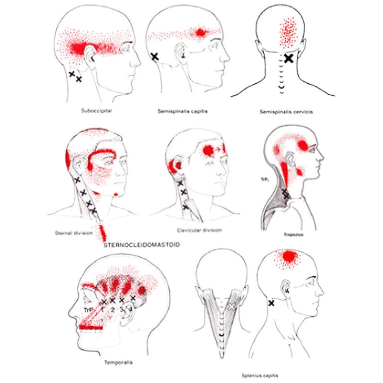 Cervicogenic Headache Trigger Points 768x768 