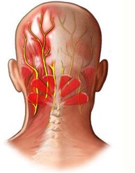 occipital nerves cervicogenic headache