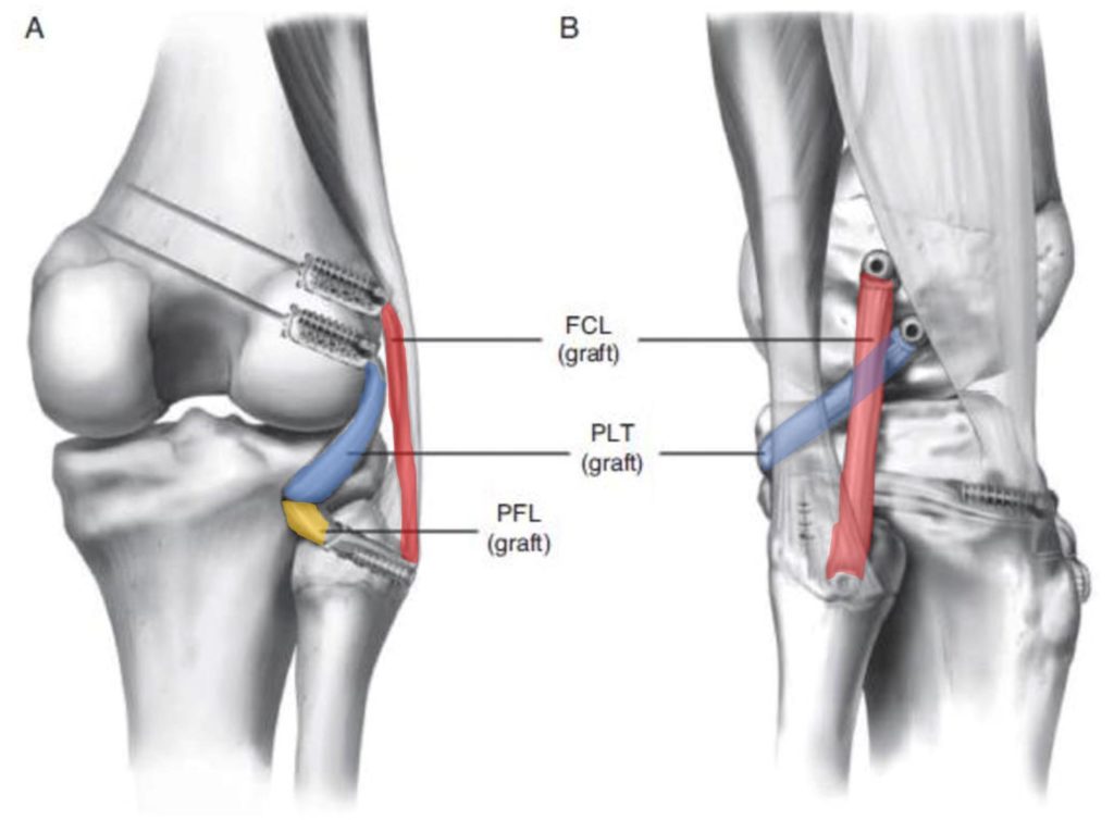 posterior lateral corner injury