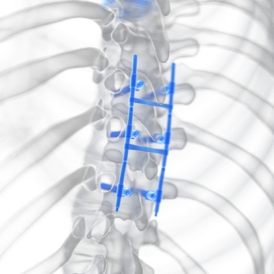 Medical illustration of a spinal fusion spinal fusion is it worth it