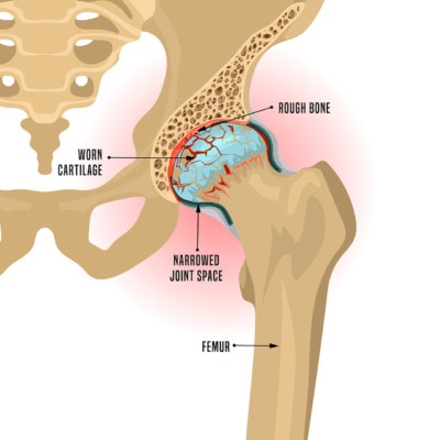 Medical infographic showing the effects of arthritis on the hip socket