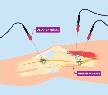 Medical illustration showing knee nerve ablation in process