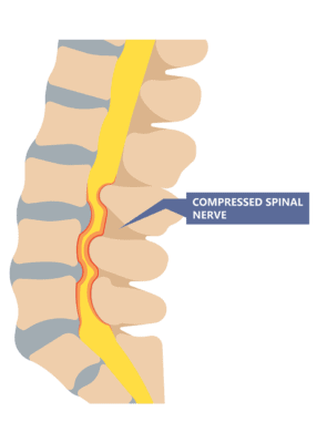 Medical illustration showing a compressed spinal nerve
