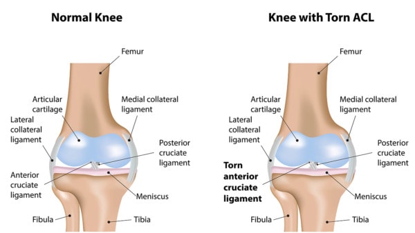 Medical illustration showing the anatomy of a normal knee versus a knee with a torn ACL