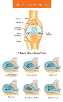 Medical illustration showing meniscus anatomy and six types of meniscus tears