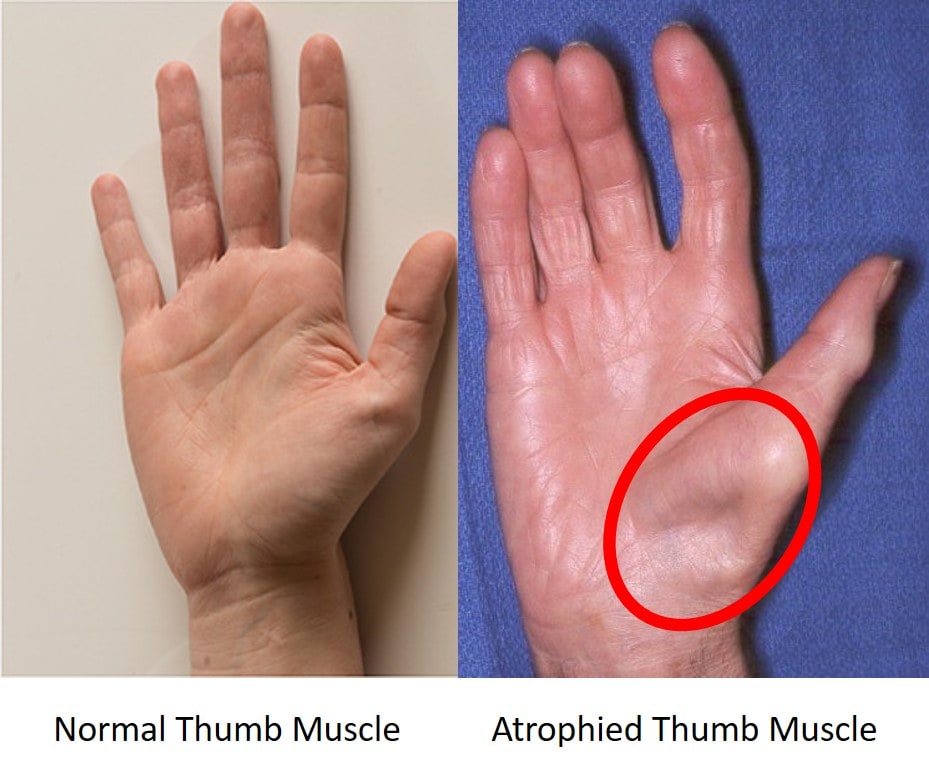 carpal tunnel surgery recovery