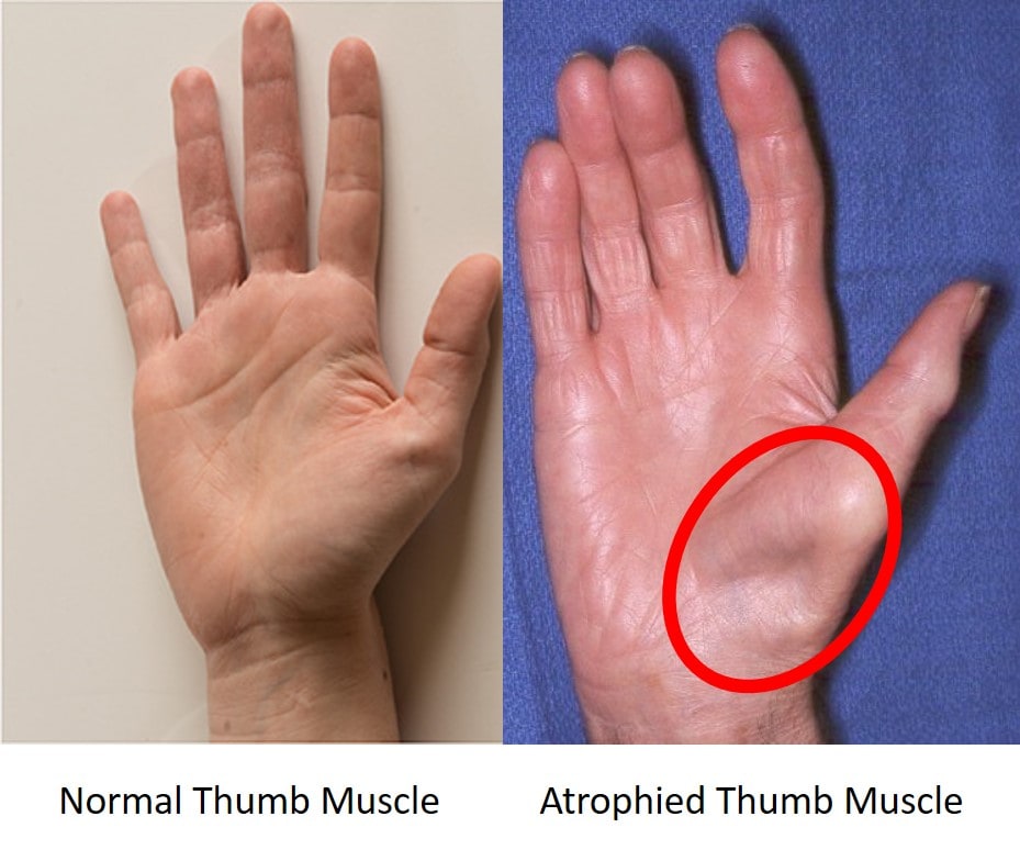 Carpal Tunnel Surgery: Preparation, Recovery, Long-Term Care