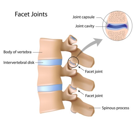 Medical illustration of the facet joints of the spine.