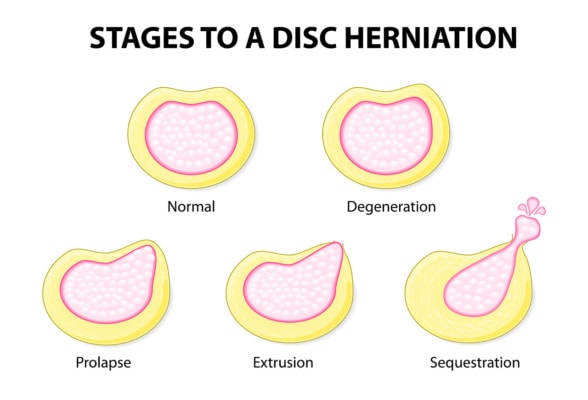 Medical illustration showing the stages to a disc herniation