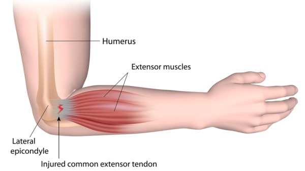 Medical illustration showing the anatomy of an arm affected by tennis elbow