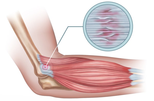 Tennis elbow diagram showing a detail of the damaged tendon tissue