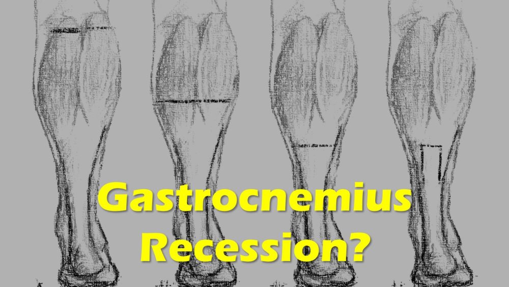 Should You Get Gastrocnemius Recession Surgery?