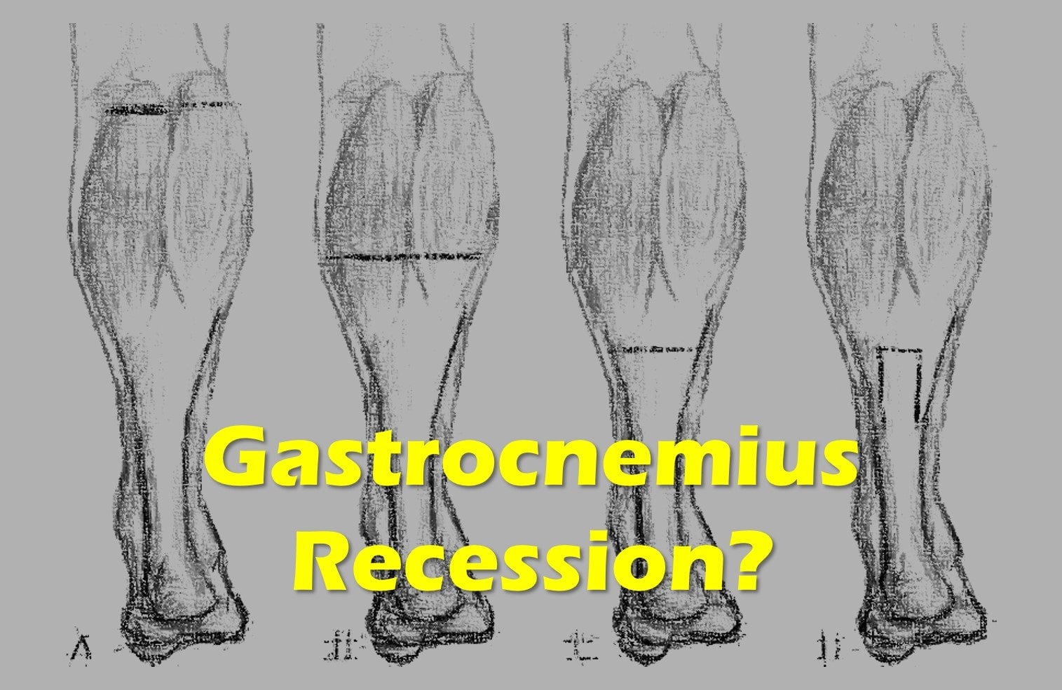 Gastrocnemius Resection