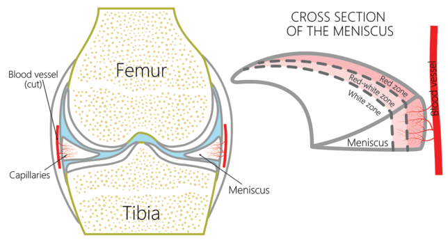 Meniscus Tear Recovery Tme Without Surgery Regenexx 3740