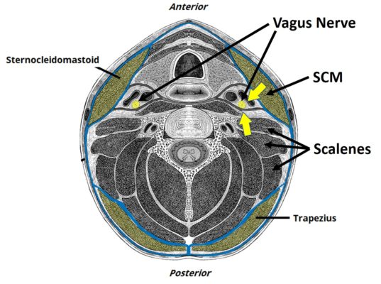 medical illustration of view across the cervical spine showing the position of the vagus nerve, sternocleidomastoid (SMC), scalenes, and trapezius.