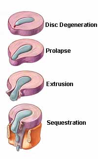 L5S1 disc bulge stages