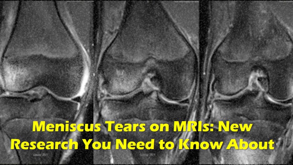 Meniscus Tear MRI?-Please Read This