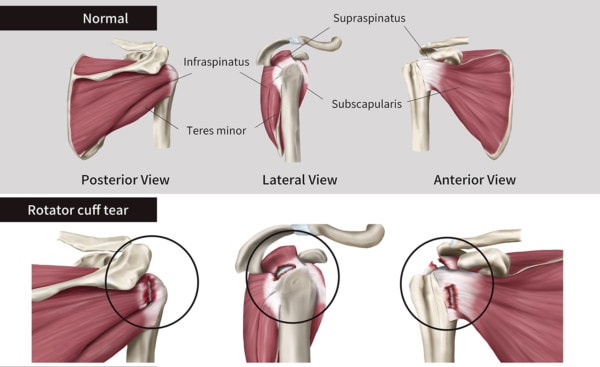 Medical infographic showing the anatomy of the rotator cuff in the shoulder and three rotator cuff tears