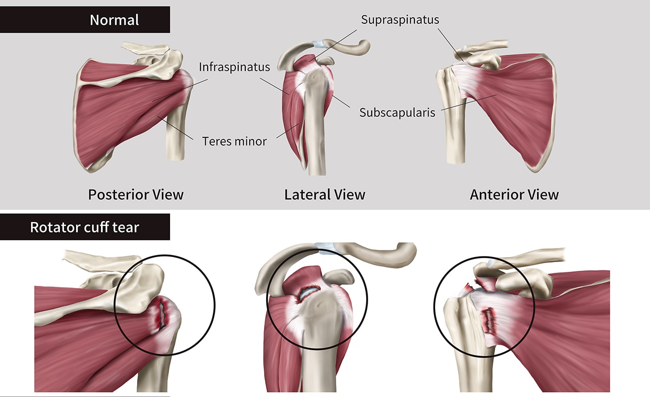 Partial rotator on sale cuff tear