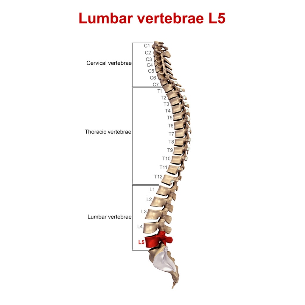 treating-an-l5-s1-disc-herniation-a-case-study-regenexx