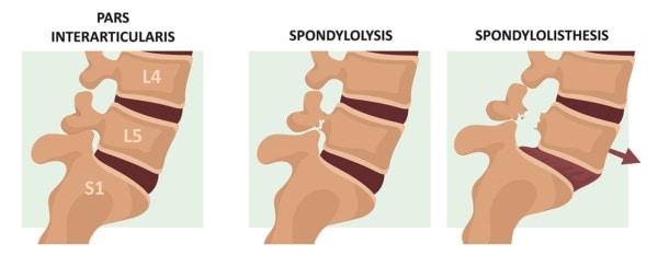 Medical illustration showing a healthy spine and spince affected by spondylolysis and spondylolisthesis