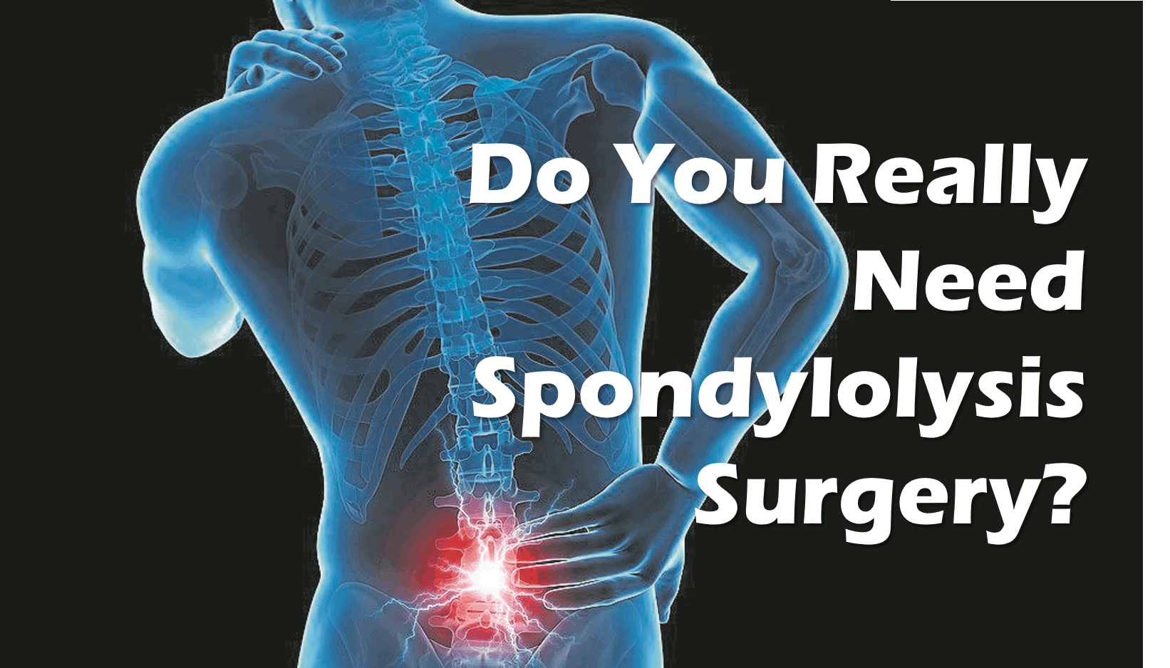 Can spondylolisthesis be cured picture