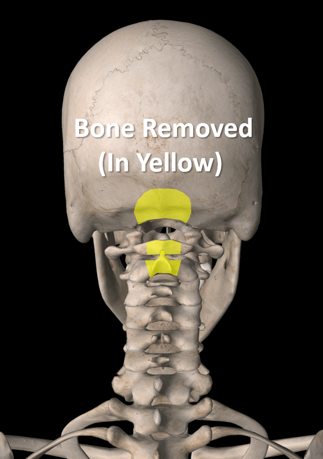 Chiari malformation treatment