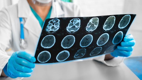 Doctor examining brain MRI in hospital