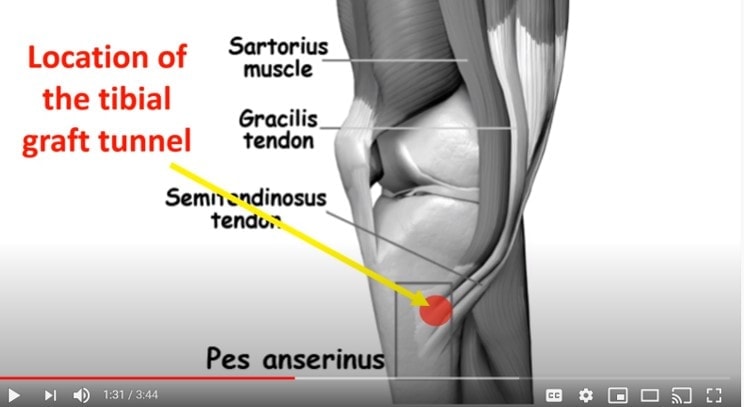 Chronic Knee Pain After ACL Reconstruction - Regenexx