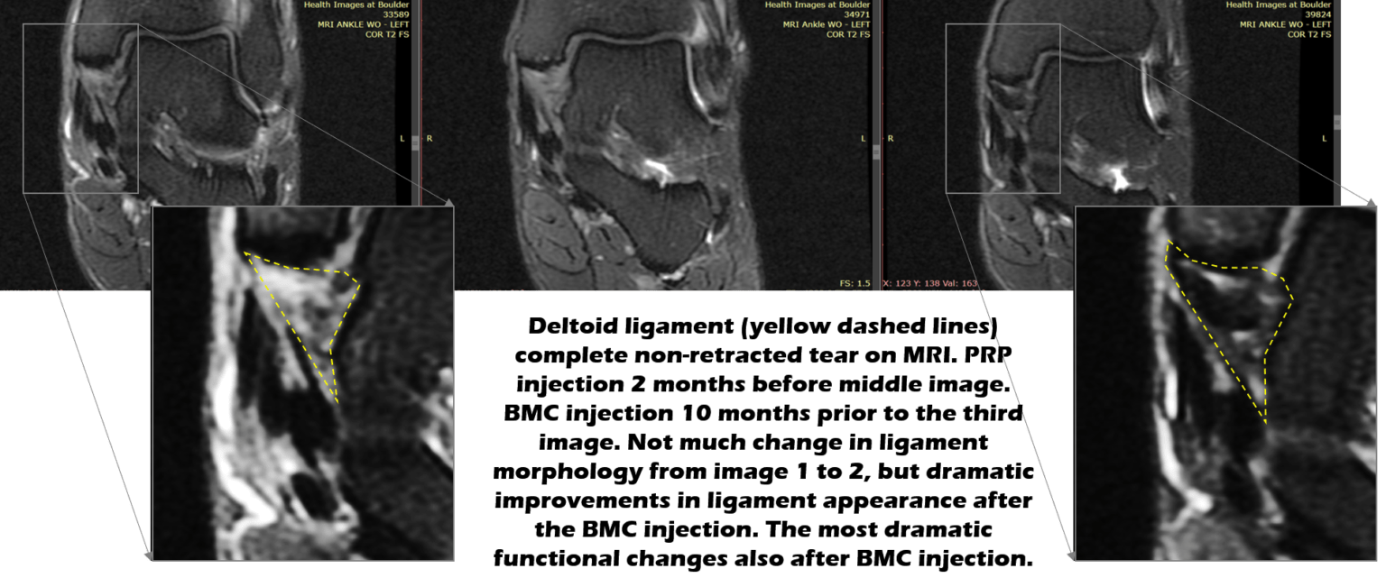 How To Heal A Torn Deltoid Ligament Regenexx 1261