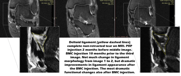 How to Heal a Torn Deltoid Ligament - Regenexx