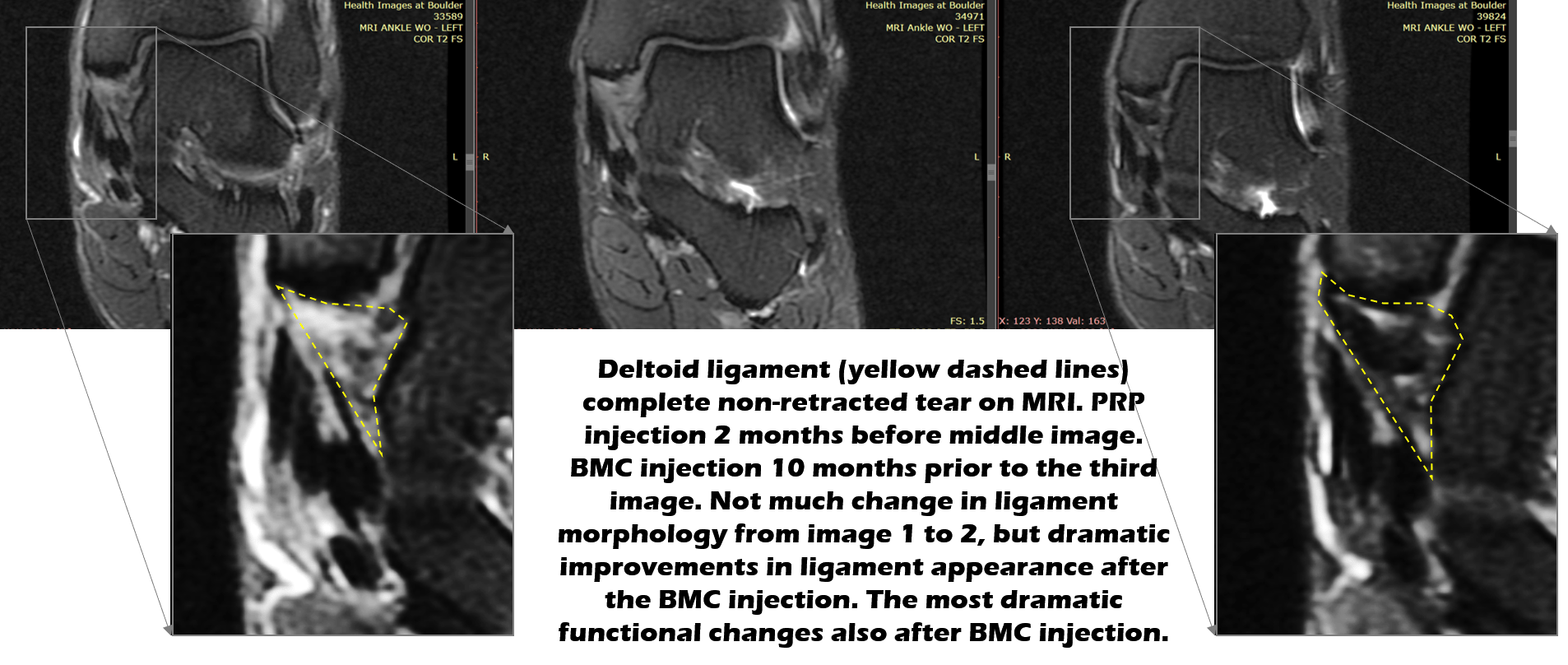 deltoid ligament injury