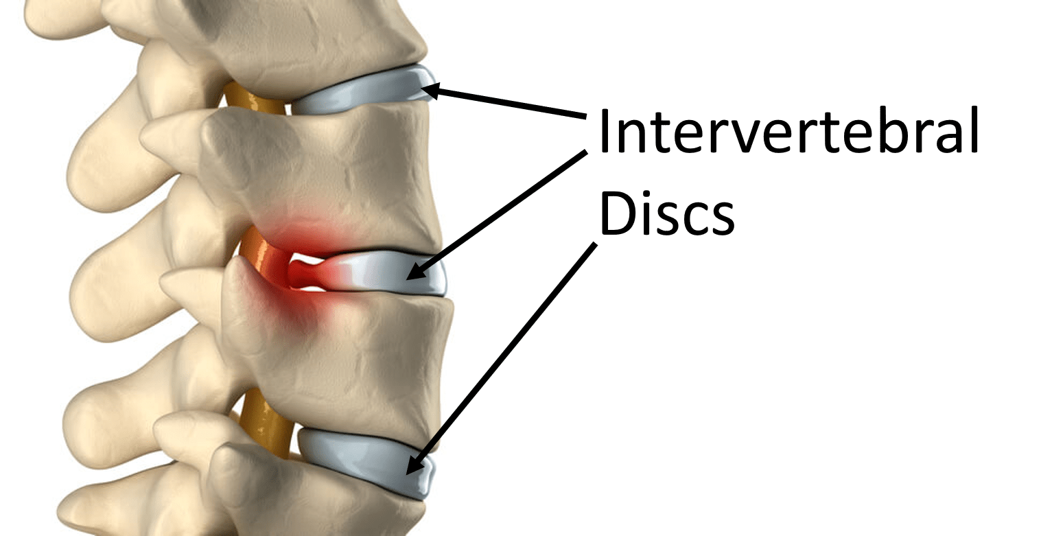 The Healthy Discs in Your Low Back Are Full of Bacteria? - Regenexx
