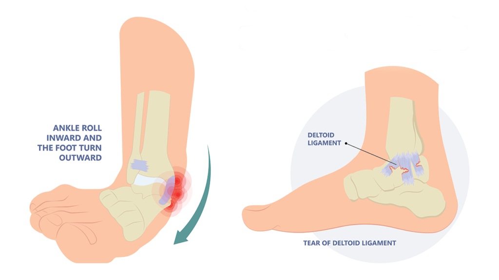 how-to-heal-a-torn-deltoid-ligament-regenexx