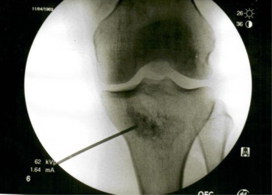 Healing Spontaneous Osteonecrosis of the Knee without Surgery