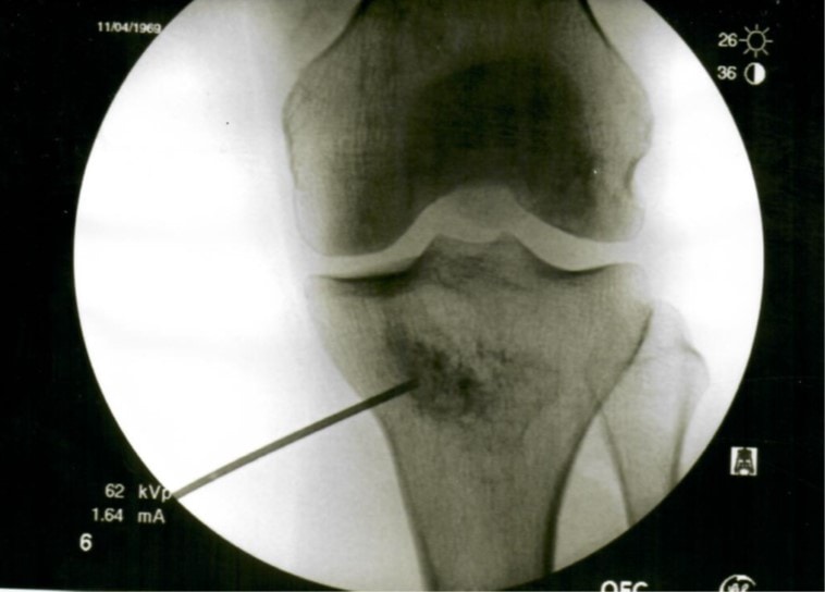 spontaneous osteonecrosis knee