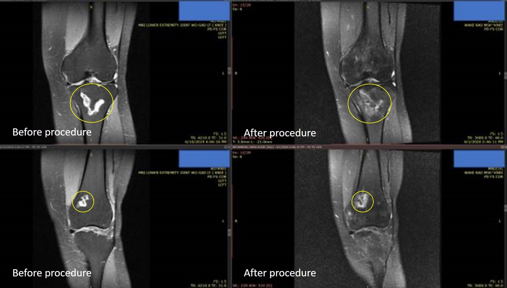 spontaneous osteonecrosis of the knee