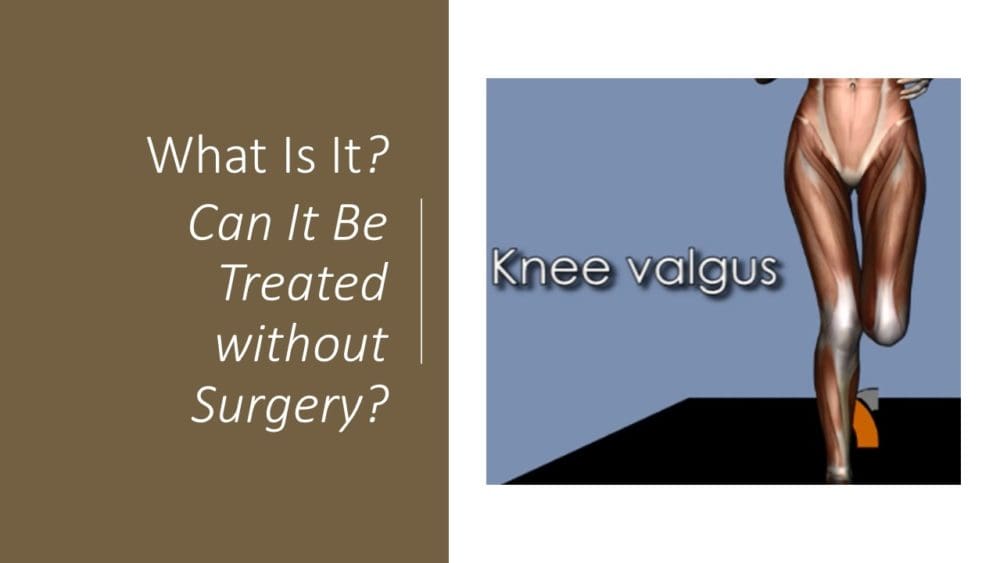 Can You Treat a Valgus Knee Without Surgery?