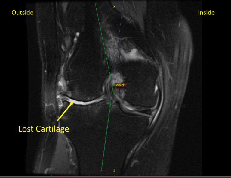 Can You Treat a Valgus Knee Without Surgery?- Regenexx