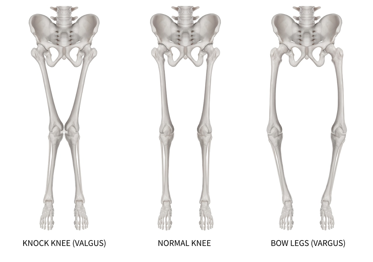 Can You Treat a Valgus Knee Without Surgery?- Regenexx