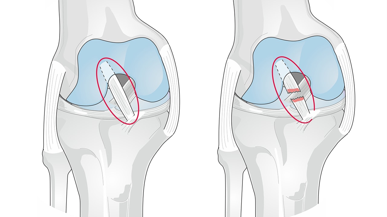 ACL Reconstruction Surgery Is a Second Hit to the Cartilage Time to