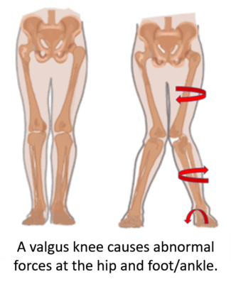 valgus knee causes hip and ankle forces